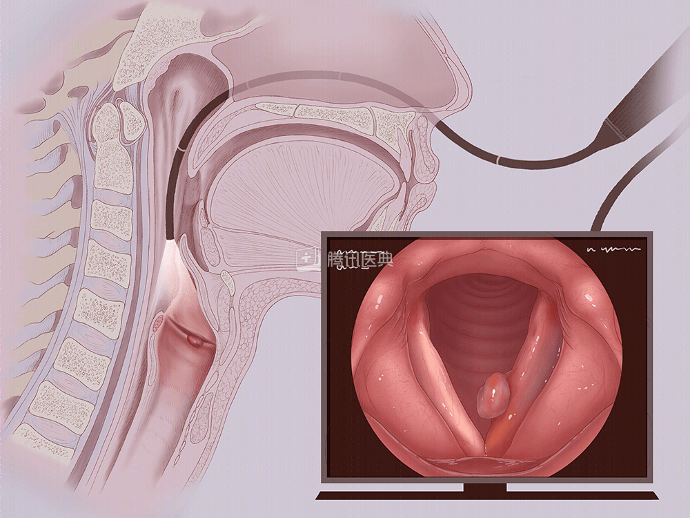 声带息肉读这篇就够了