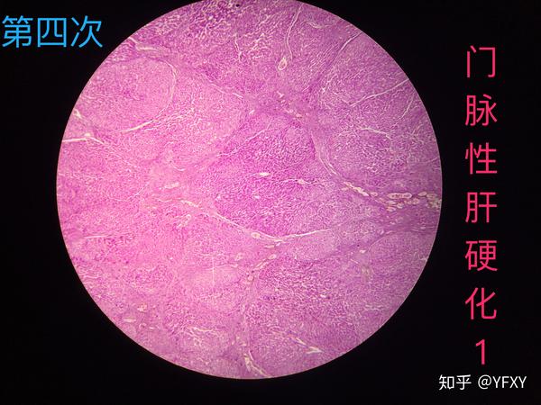 主动脉粥样硬化,6.大叶性肺炎,7.门脉性肝硬化,8.