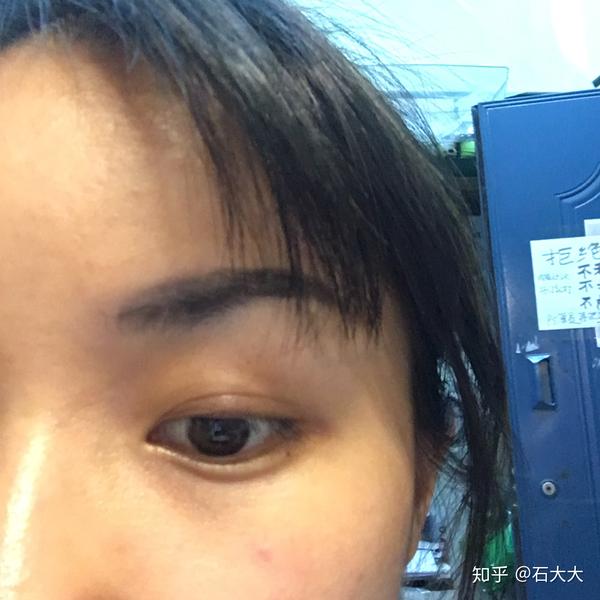 麦粒肿不要怕 - 知乎