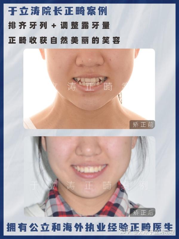 太原牙齿矫正|反颌面中部凹陷,不能拔牙矫正,如何改善
