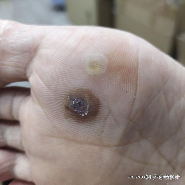 跖疣病情简单记录冷冻治疗