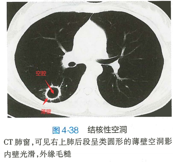 ⑥半月综合征(溃疡型胃癌)