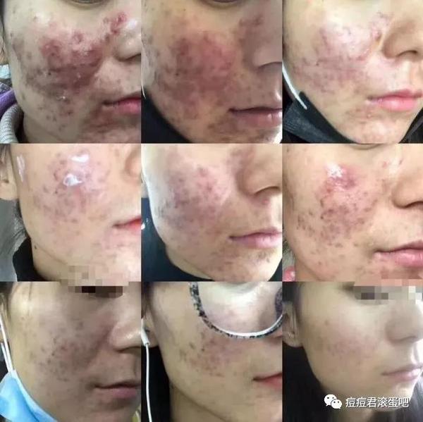 重度四级:结节/囊肿性痤疮或聚合性痤疮,总皮损大于100个,结节/囊肿