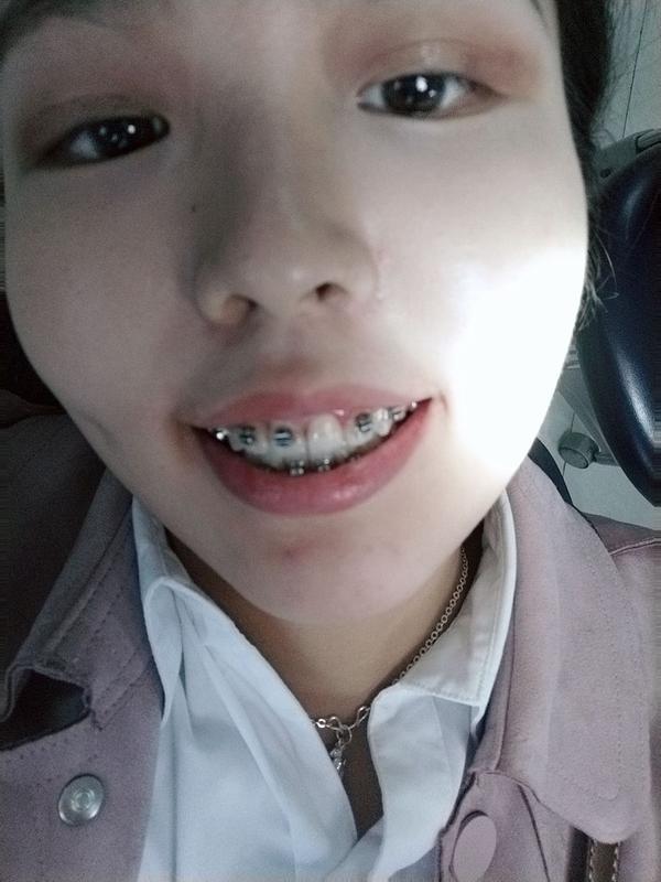 牙齿矫正对个人外貌变化有多大影响?