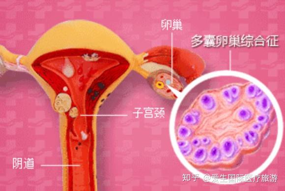 多囊卵巢≠不孕,找对方法一样能怀孕