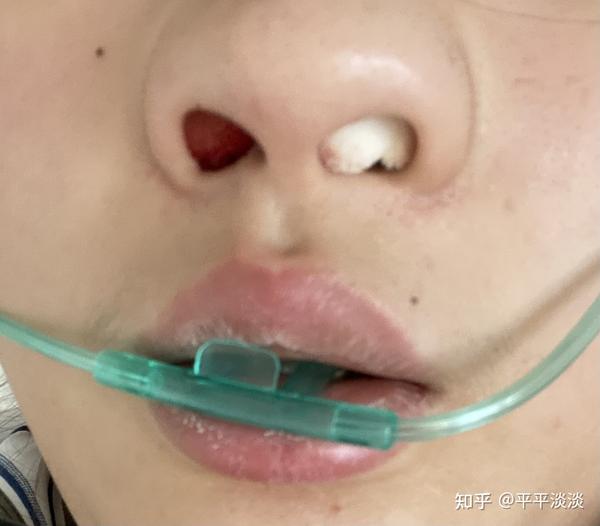 鼻窦炎手术详细过程 鼻中隔弯曲 双侧下鼻甲肥大