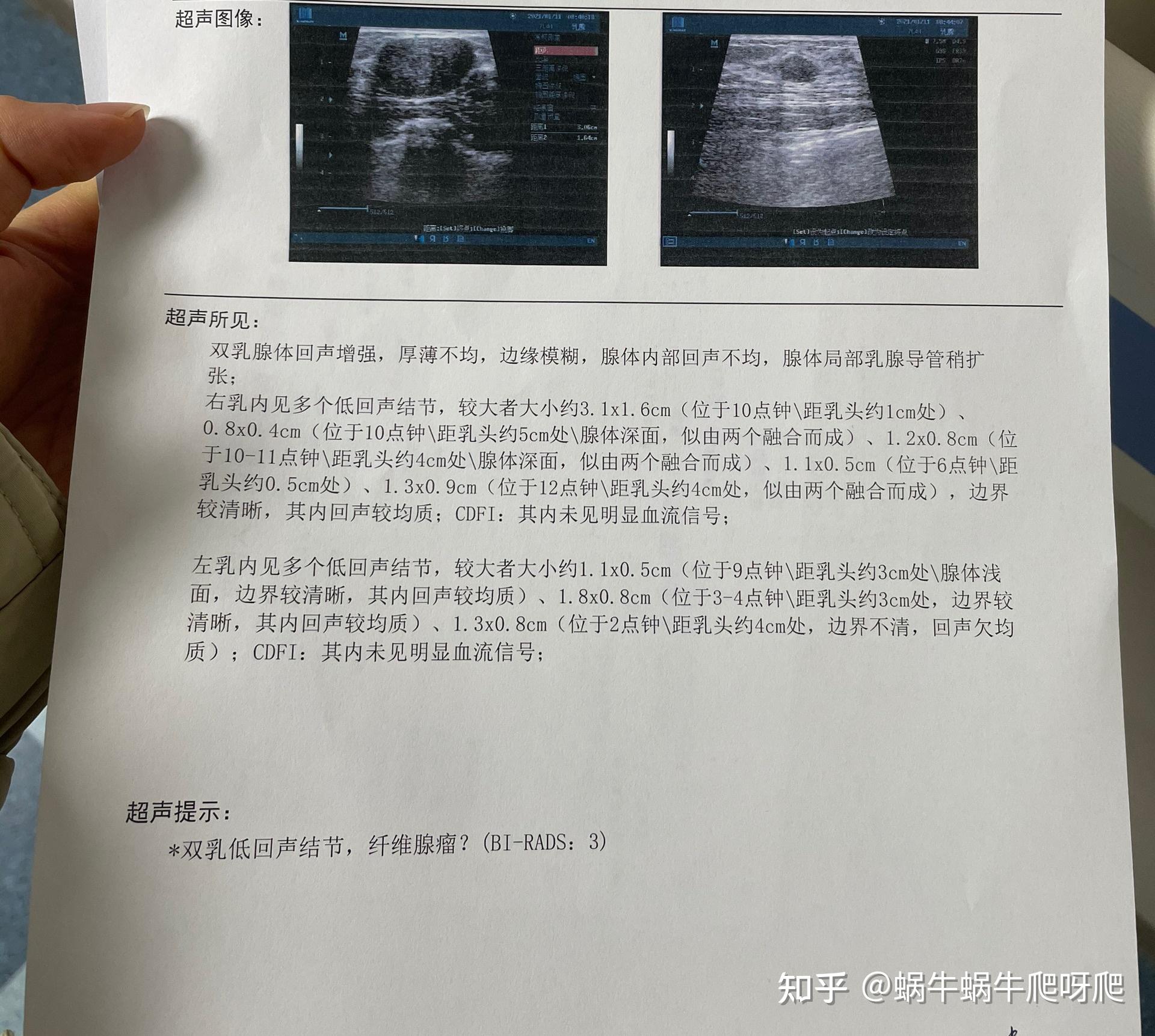 困扰我多年的乳腺纤维瘤问题终于不用再提心吊胆了