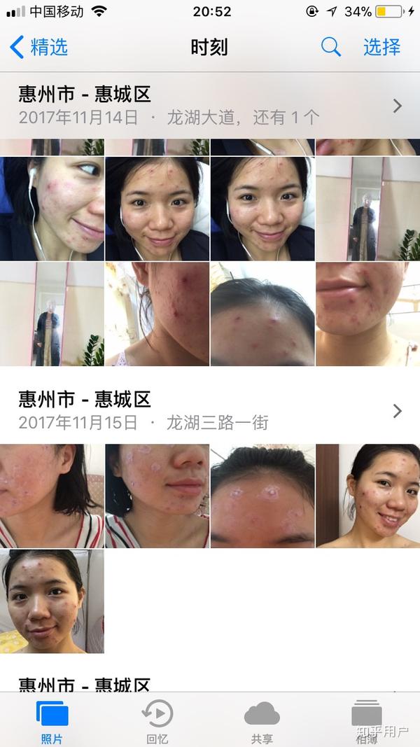 长水痘是一种怎么样的体验?