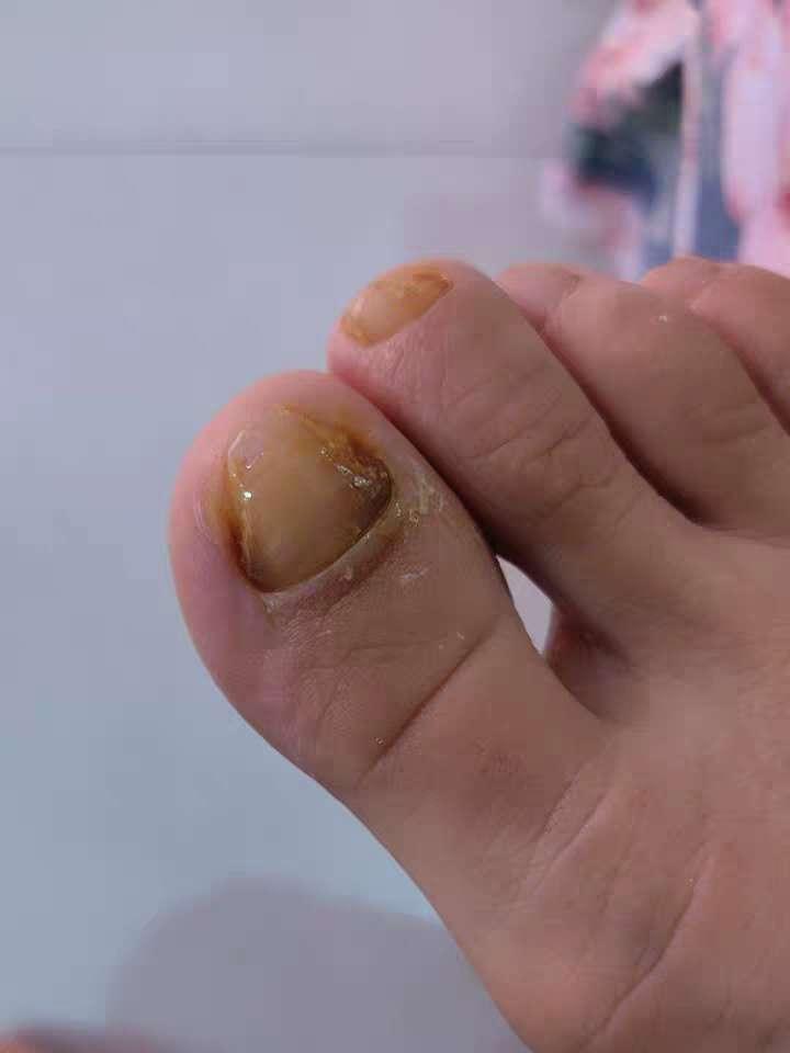 亮甲治疗灰指甲效果好不好