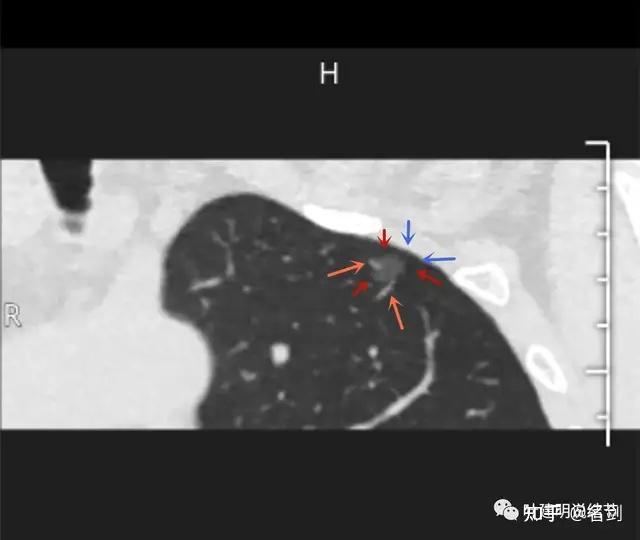 红色示瘤肺边界清,桔色示血管征上图桔色箭头所示见血管进入病灶并穿