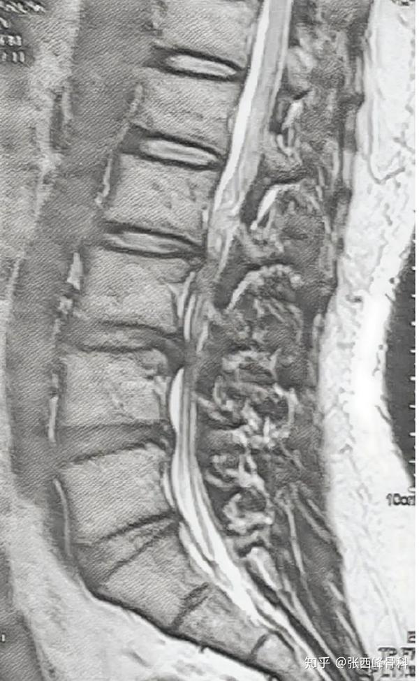 【病例分享】多间隙腰椎管狭窄症是否可以选择微创治疗?