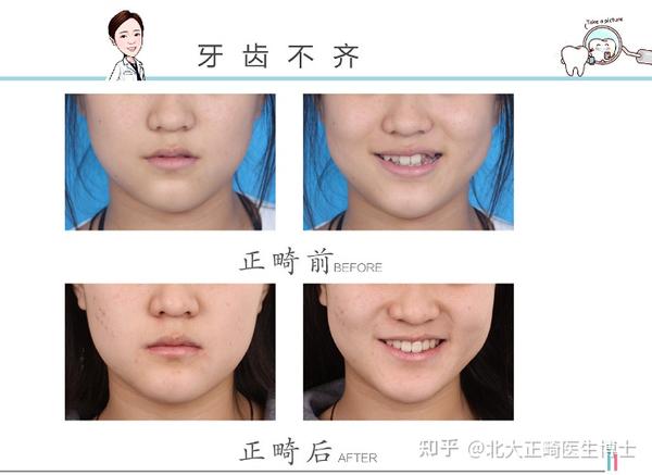 牙齿矫正:微凸vs直面型哪种好看呢?