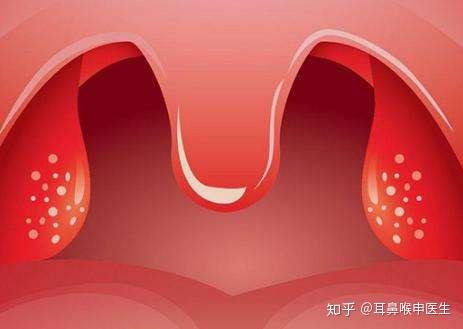 怎么用筷子快速判断孩子的扁桃体有没有发炎