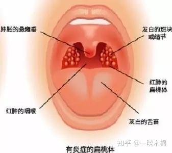 扁桃体老发炎该不该切