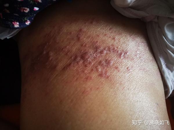 肺癌晚期临终关怀怎么做?