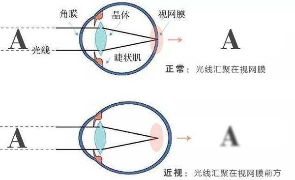 眼的屈光系统无法成像在视网膜上,而只能成像在视网膜之前时,近视就