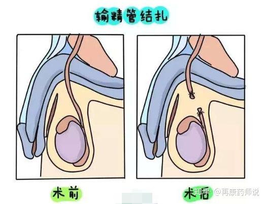 男性结扎手术效果非常好, 避孕率极高,不过在术后前三个月依然要做好