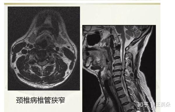 椎管矢状径小于 10mm为绝对狭窄                             10