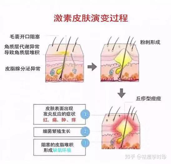 激素依赖性皮炎毛孔粗大怎么办还有救吗