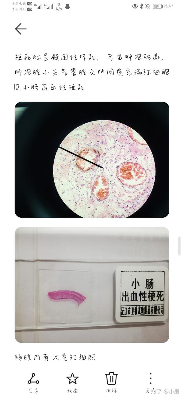 部分病理学切片红蓝铅笔手绘图,画的有一点点丑