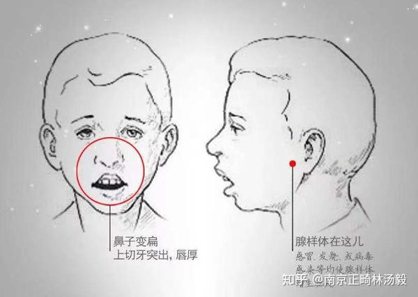 通常,我们牙医也把这类病例叫做腺样体面容