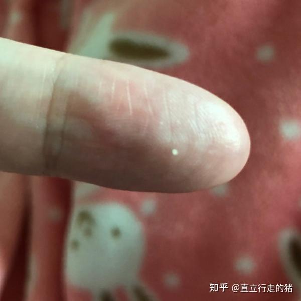 头皮上有油粒固体小颗粒喜欢扣出来那油粒到底是什么怎么形成的有什么