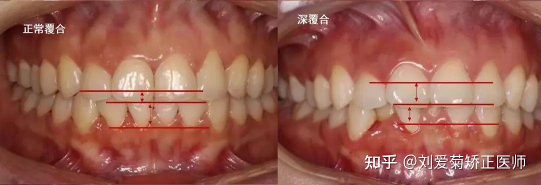 出现深覆合要注意了ta的危害你想象不到