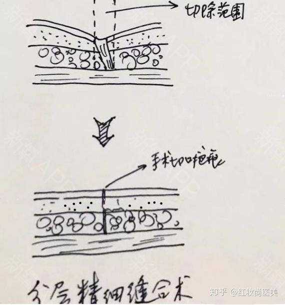 (脂肪层)的切开,彻底清除挛缩和存在炎性细胞的皮下组织,再做美容缝合