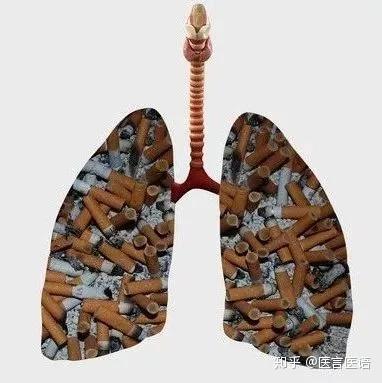 肺癌的早期信号这种异常咳嗽尤为注意