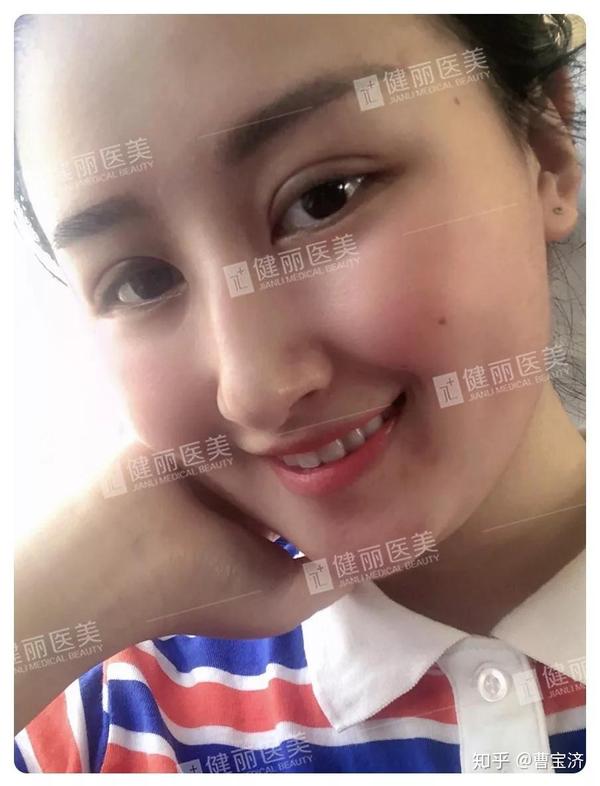 双眼皮做哪种形状好?纠结了10年,为什么她还是选了开扇形?