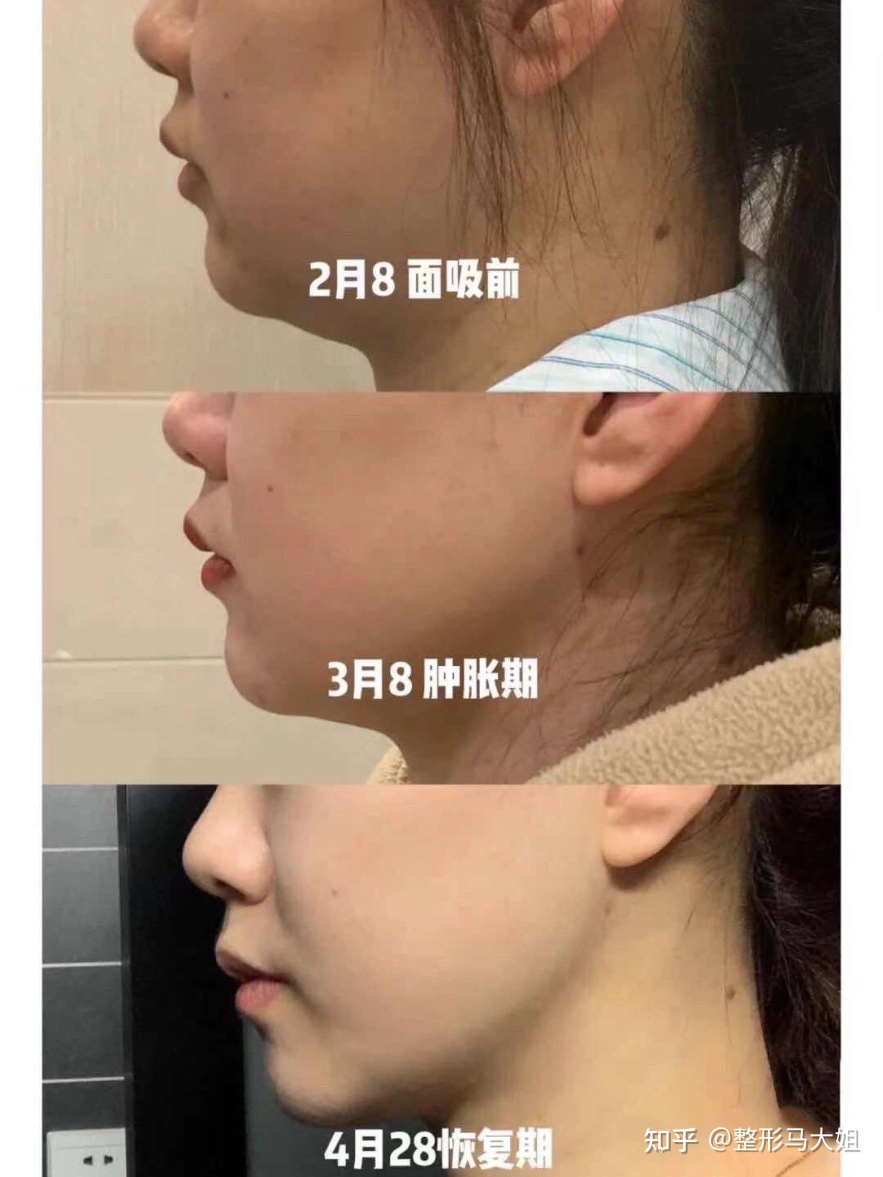 去除双下巴,应该选面部整体吸脂还是下巴吸脂?