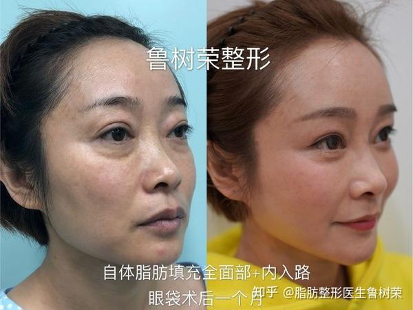 如何区分卧蚕,眼袋和泪沟?