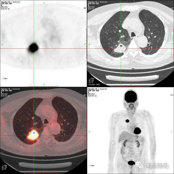 西安高尚医学影像:pet/ct在肿瘤治疗决策中的应用