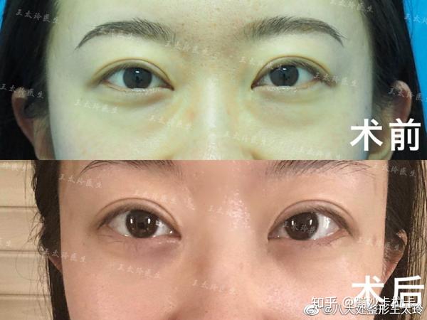 眼袋和眶隔脂肪释放手术医生攻略