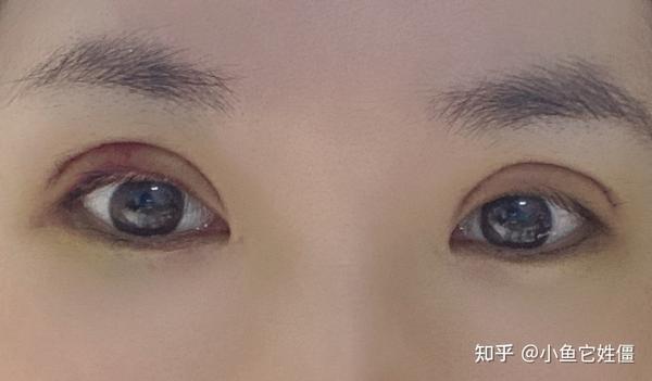 对,我做的6mm的双眼皮,因为我喜欢自然的,后期内双我都无所谓 只求不
