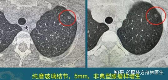 肺磨玻璃结节不一定是恶性肿瘤,导致磨玻璃结节出现的病因有很多