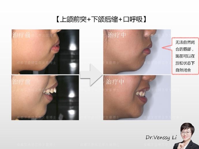 成都牙齿矫正李文星博士:『上颌前突 下颌后缩』微调中案例分享