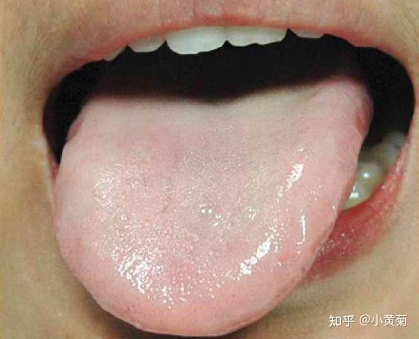 舌苔 苔质:薄少; 苔色:白. 【临床意义】 气血亏虚,破