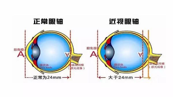 揪出近视眼轴变长的幕后推手!