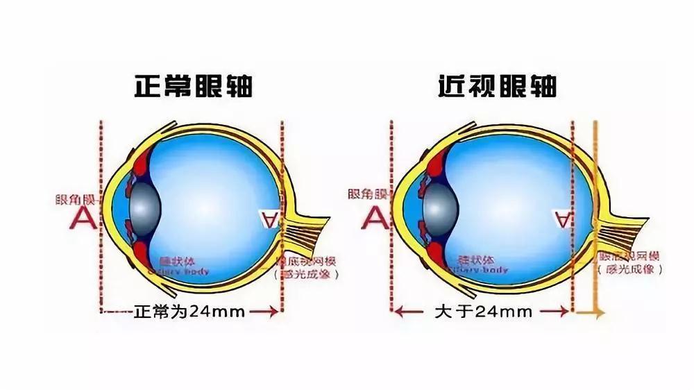 揪出近视眼轴变长的幕后推手