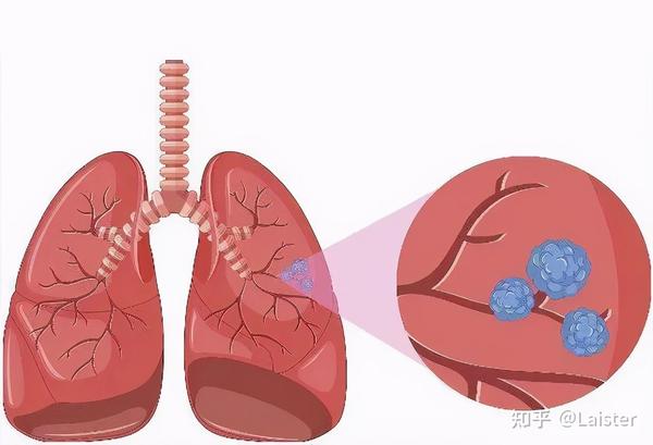 为什么说非小细胞肺癌活得比小细胞肺癌更久 知乎