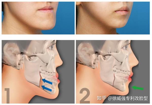 1,一般脸型地包天,脸部长度正常,但患有地包天的脸型.