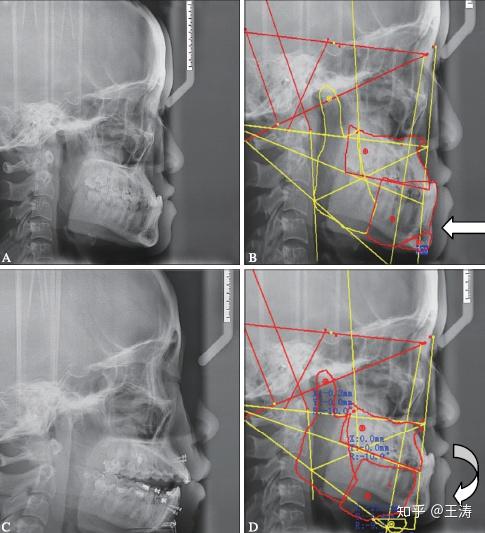 图 4   a:术前头颅侧位片;b:"整体平衡头影测量"与上下颌骨二维