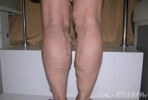 静脉曲张不能自愈别等出现大问题再后悔