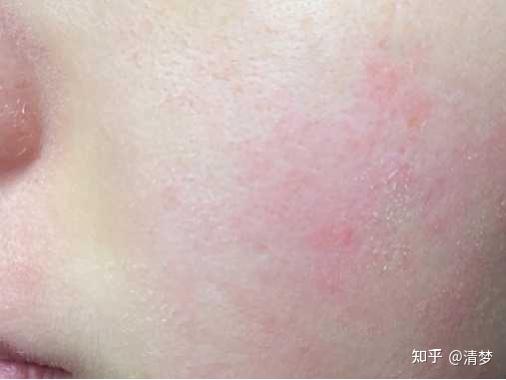 有没有适合学生党的平价好用的面霜起干皮换季敏感皮肤泛红皮肤暗黄