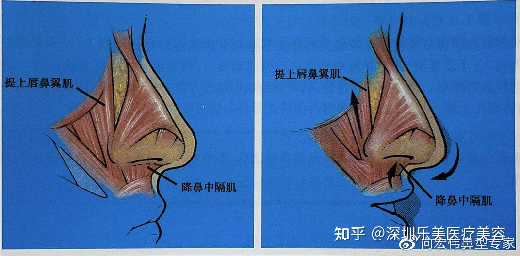 鼻中隔(内侧),鼻底(内下方),下鼻甲(外侧)以及上外侧软骨尾侧缘(上方)
