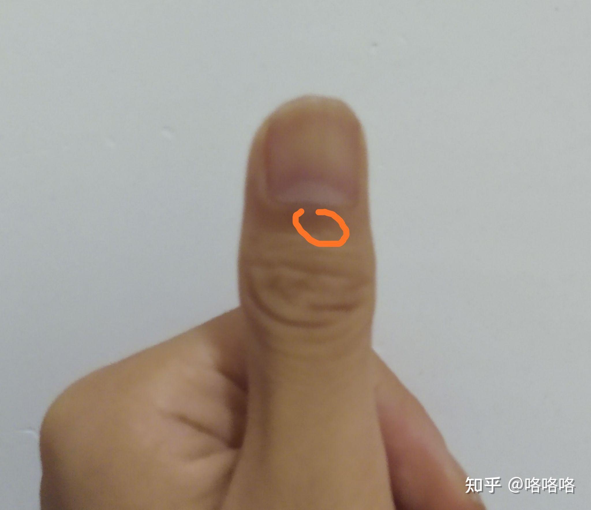 电手心首先,先给针消毒,再往每个手指上扎,直到10跟手指扎完.