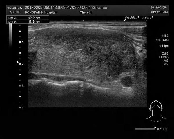 亚急性甲状腺炎