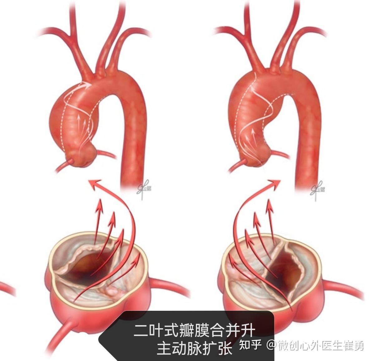 一天两台无可见疤痕微创wheat升主动脉主动脉瓣置换手术