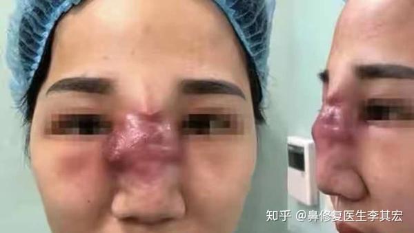 因为注射劣质玻尿酸导致的玻尿酸下行造成了鹰钩鼻的情况.